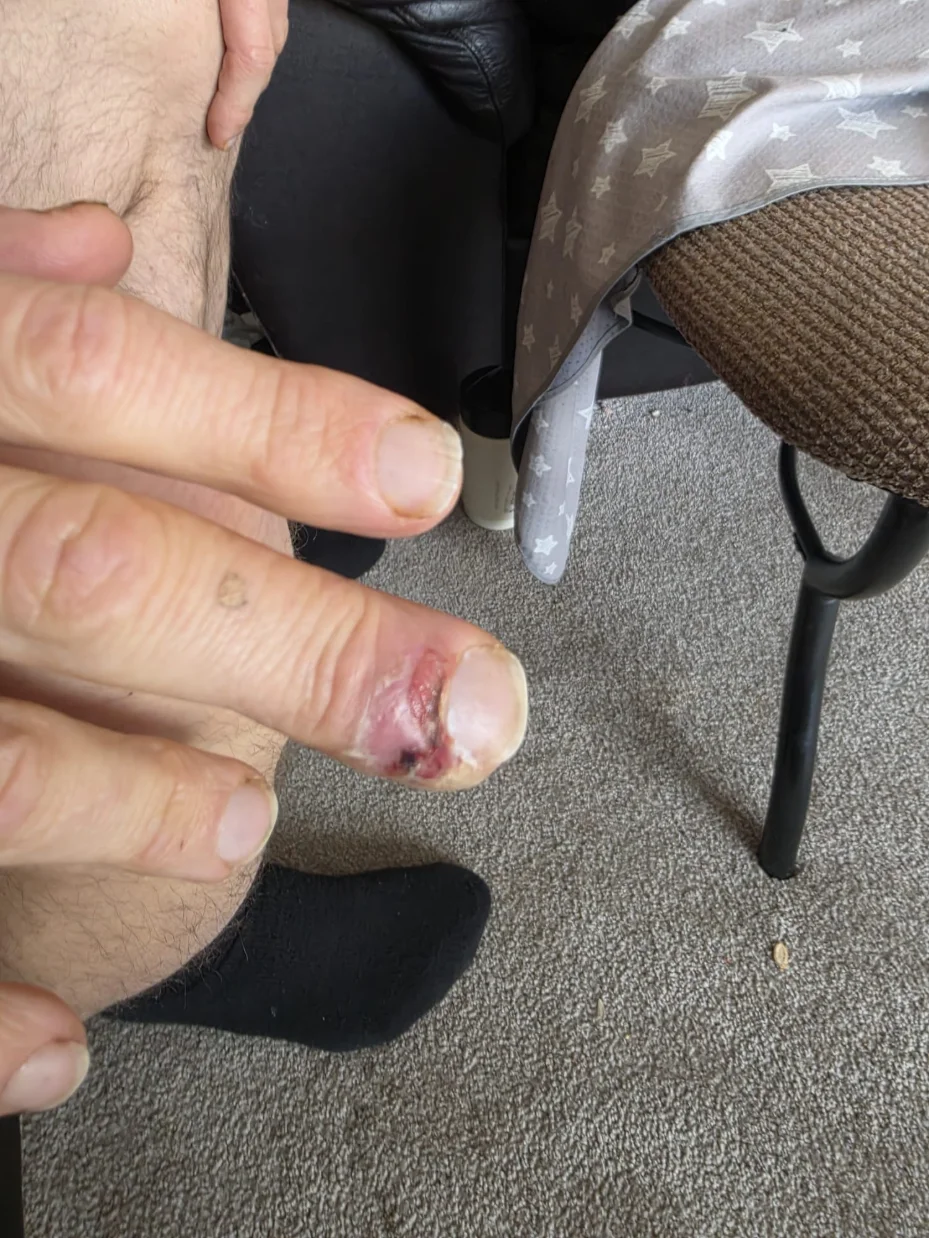 David's hand showing the paronychia infection that led to a Parkinson's health crisis