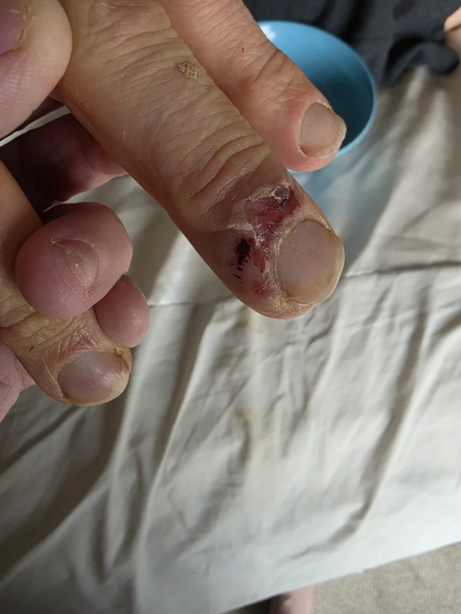 Close-up of an infected fingernail bed with broken skin and dried blood, showing the actual wound that caused near-fatal Parkinson's complications.